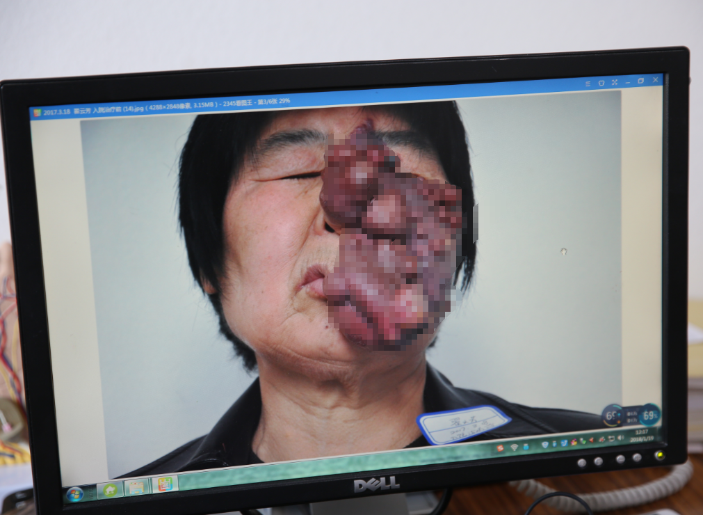 济南现代皮肤病医院胎记科李娅主任介绍说,孙女士刚刚出生时,脸上只有