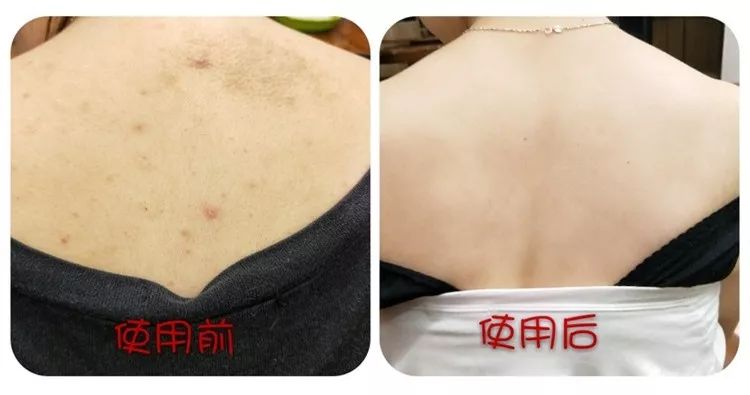 后背有一块皮肤像鸡皮(后背和肩膀上的皮肤像鸡皮一样是怎么回事) 后背有一块皮肤像鸡皮(后背和肩膀上的皮肤像鸡皮一样是怎么回事)