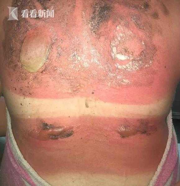 女子潜水背上晒出俩水泡网友你需要多戴个胸罩