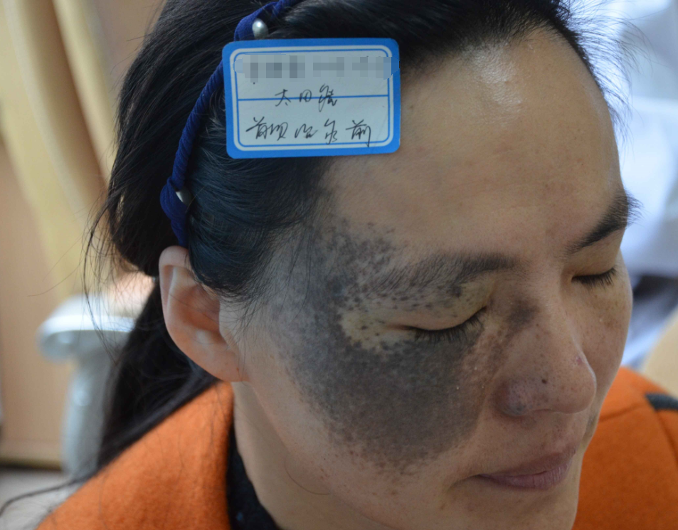 42年太田痣如影随形,治疗三次成功"变脸"