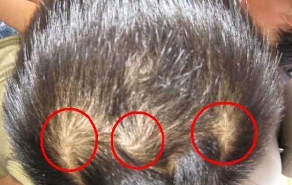 宝宝头上一个旋、两个旋、三个旋,这真能影响孩子的性格吗?