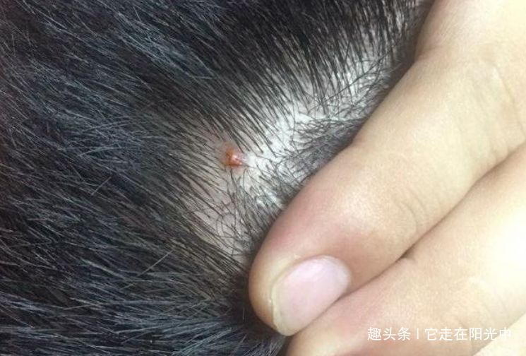 一揪粒米就下来,用1妙招就除净|微生物|头皮|米粒_新浪新闻