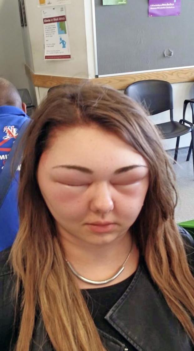 爱美的代价英女子染发变猪头脸肿成3倍大双眼无法睁开