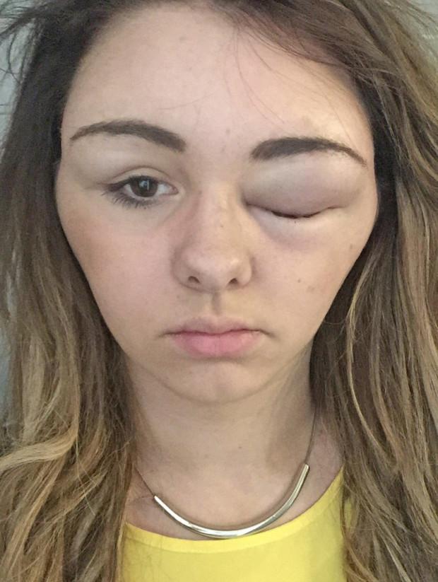 爱美的代价英女子染发变猪头脸肿成3倍大双眼无法睁开