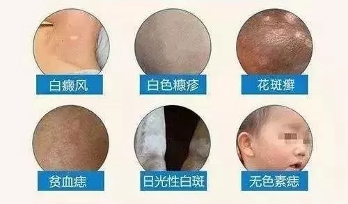 6岁女孩因白癜风误诊为白色糠疹被耽误多遭的罪