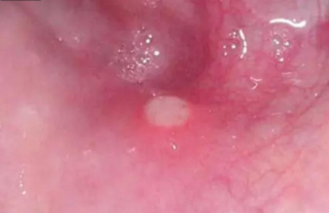 疱疹用什么药最好最快 ca22-iaqfzyw2543334.jpg