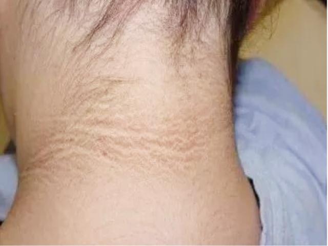 孩子洗不白的"黑脖子"不是脏,而是患了这种病,家长赶紧看看