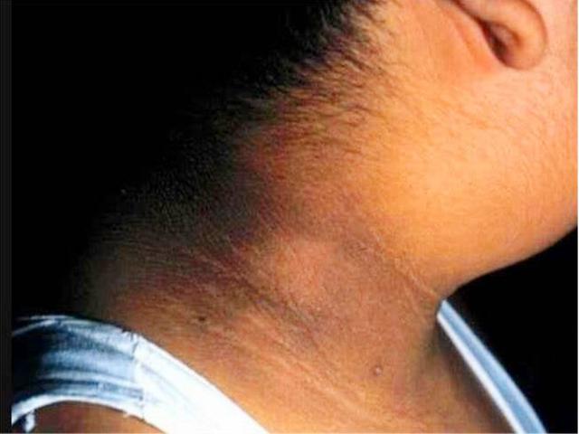 孩子洗不白的"黑脖子"不是脏,而是患了这种病,家长赶紧看看