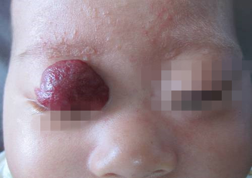 眼部血管瘤危害严重家长必须要重视