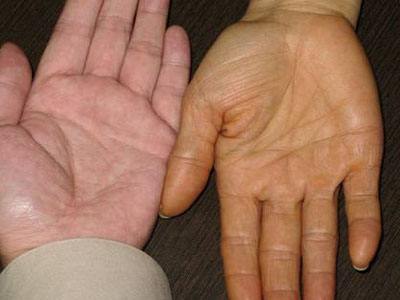 此时血液传染乙肝病毒成为主要传播途径,例如成年后乙肝两对半结果为