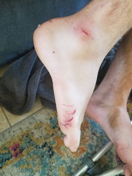 彼得称一条4英尺(约1米2)的鲨鱼在他站在海滩上时咬伤了他的右腿,鲨鱼