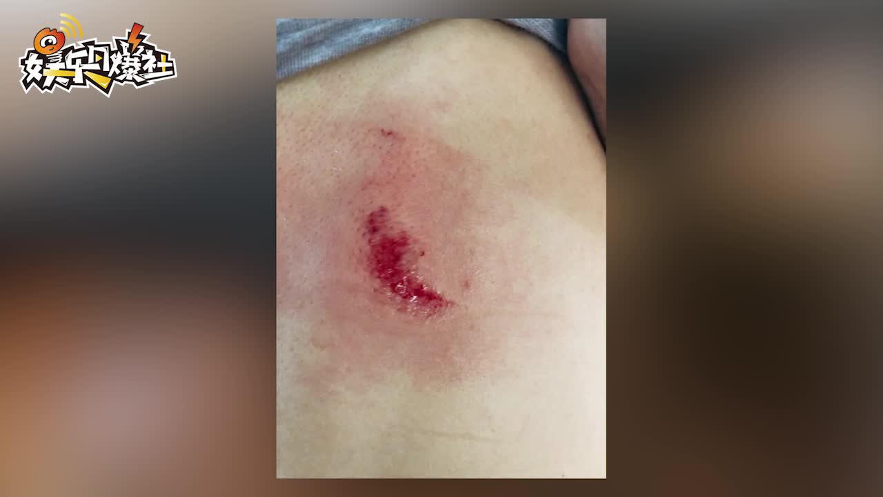 妈妈被柜子压倒背部受伤 张馨予发文问责家具售后