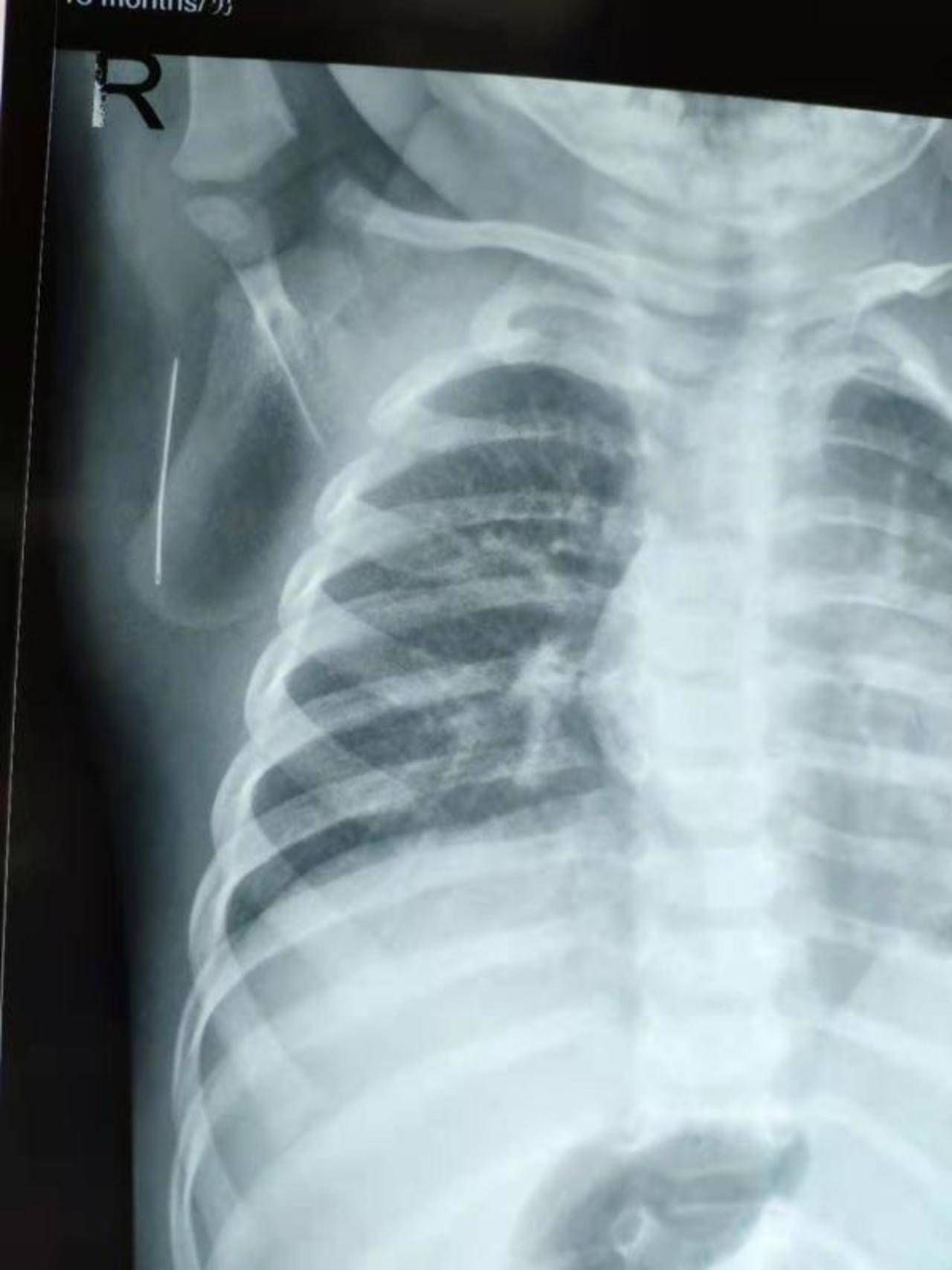 怀疑伢肺炎拍片意外发现异物绣花针蹊跷扎入男童肩胛骨下