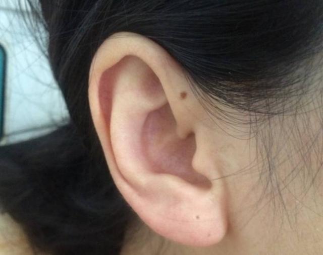 好痣可招贵人帮助,恶痣则败尽家财,耳朵上有痣,到底是福是祸?