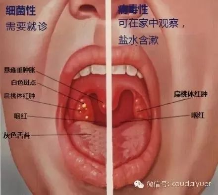 宝宝"喉咙红了"怎么办?