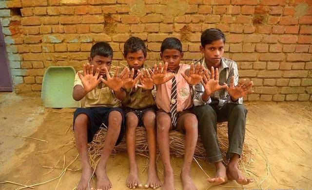 印度一家25人600只指头,个个都是六指,遗传的威力真大!