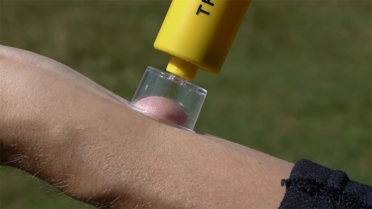 国外发明能吸出毒液工具