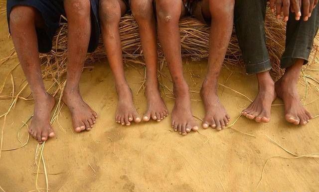 印度一家25人600只指头,个个都是六指,遗传的威力真大!