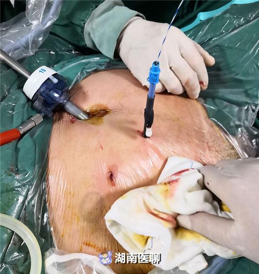 男子腰腹疼一星期,发现异位肾!医生开1cm小口取结石