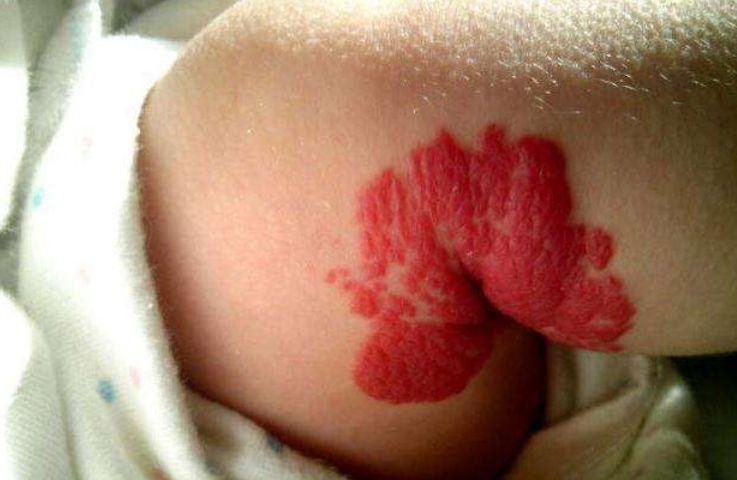新生儿红色胎记图片
