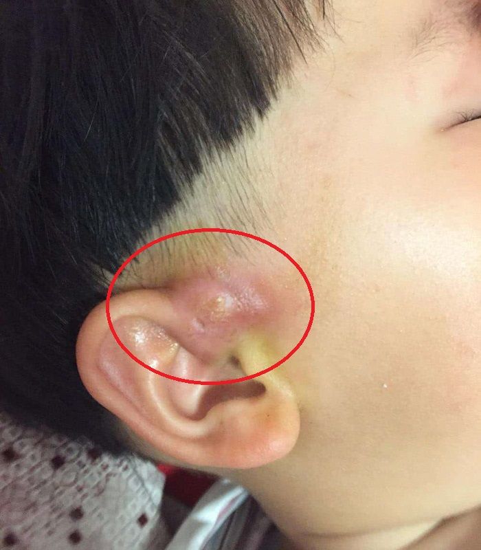 宝宝耳朵上有个小洞,老人说孩子有福气,医生的话让妈妈吓了一跳