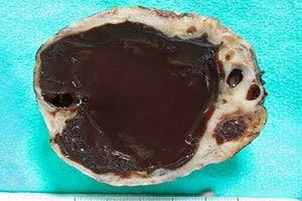 巧克力囊肿你了解多少