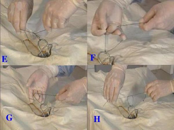 其实结扎非常简单,把男子的输精管进行阻断,这样精子就无法排放出来与