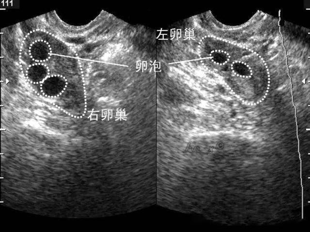 同时还能测出优势卵泡的大小,子宫内膜的厚度等