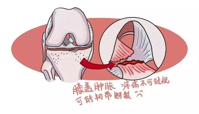 「附保護膝蓋3秘招」|關節炎|痛風_新浪新聞