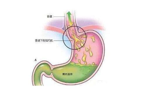 患上了胆汁反流性胃炎治疗就靠它了你也可以借鉴一下真管用