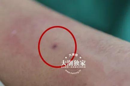 【警惕】被马蜂蛰了涂风油精会要命?这种错误大多数人还在犯!