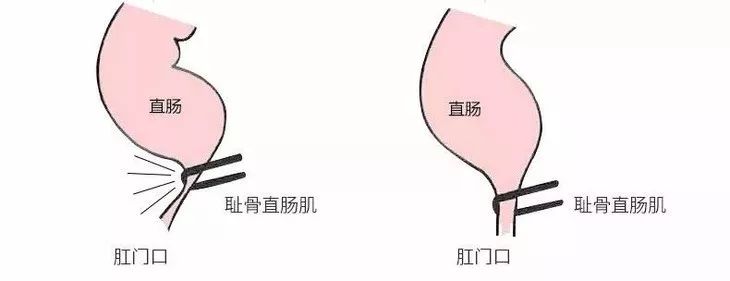 肛肠角越大,直肠越直,排便就越顺利形成了一个"肛肠角"原来人体重有