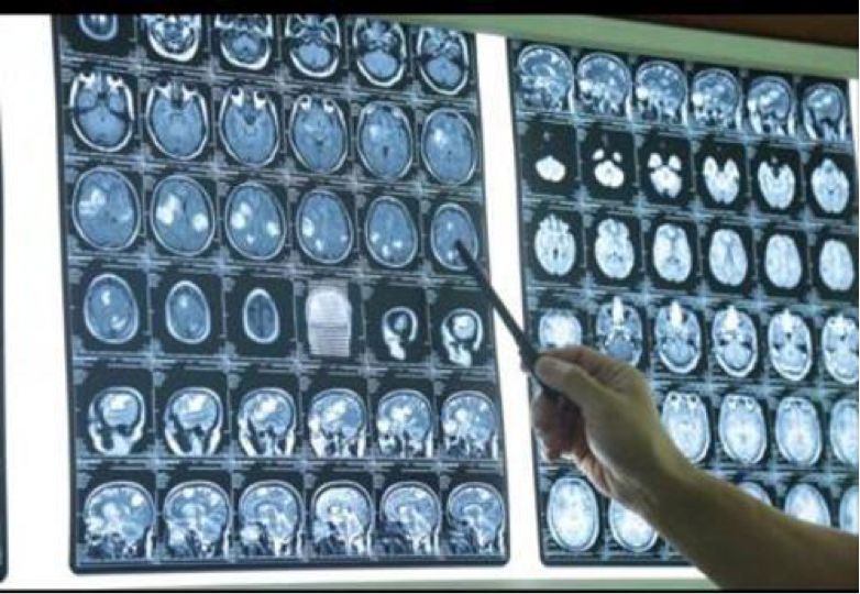 寄生虫病|脑内有虫致癫痫发作六年,竟是吃猪红惹的祸!