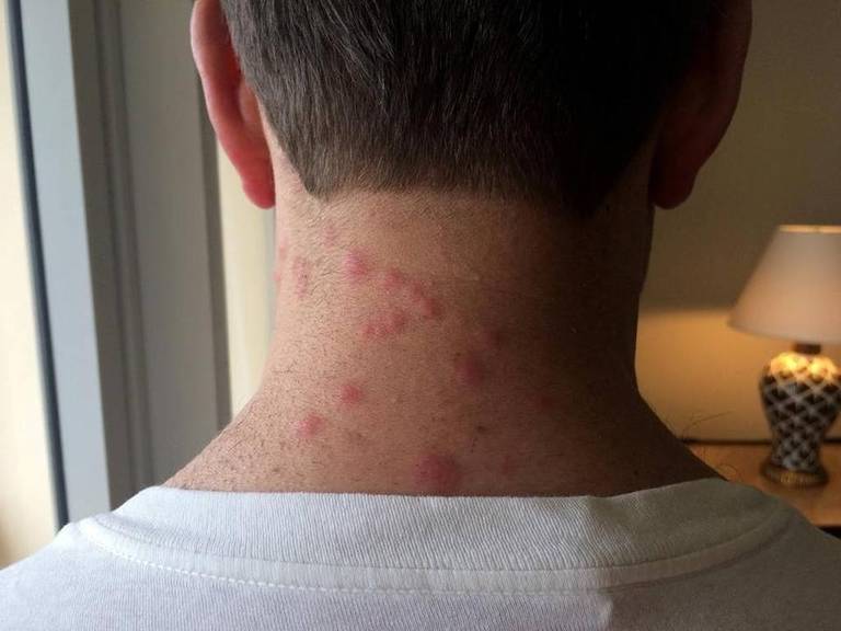 埃里克·林德尔展示被臭虫咬伤痕迹 图自迈阿密先驱报同年7月,林德尔