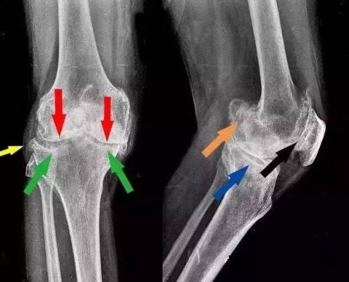 骨质增生的原因有哪些医生提醒注意5点重了住院就划不来了