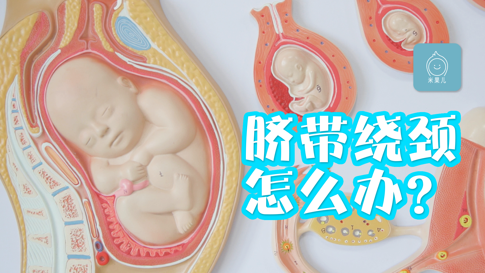 脐带绕颈能不能顺产99孕妈妈都关注