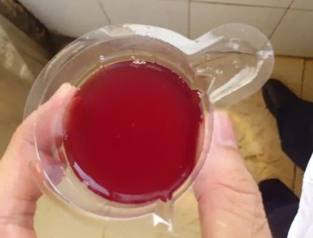 的食物或者药物,而出现小便尿血(尿液颜色像洗肉水)的情况要引起重视