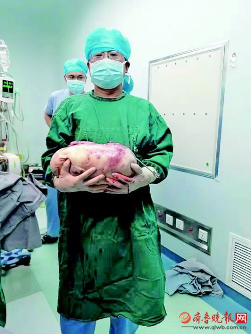 肚大如怀胎十月竟是肿瘤作祟28斤肿瘤取出后女孩轻了50斤