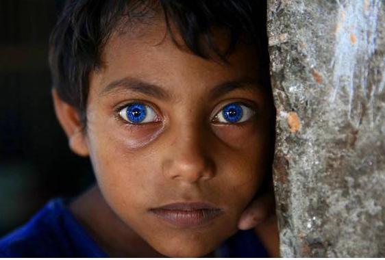 这种遗传病的宝宝天生拥有宝石般的眼睛,却让爸妈们伤心欲绝