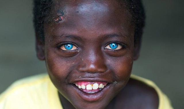 这种遗传病的宝宝天生拥有宝石般的眼睛,却让爸妈们伤心欲绝