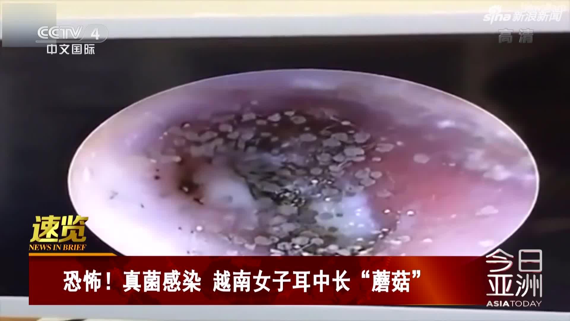 真菌感染后越南女子耳中长"蘑菇"