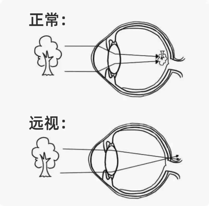 远视眼|近视眼_新浪新闻