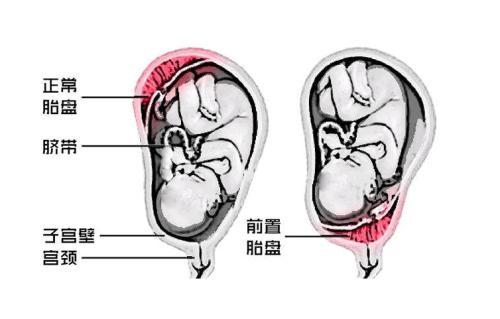 怀孕后,胎盘前壁后壁有什么区别?这种位置很危险,孕妇要多注意