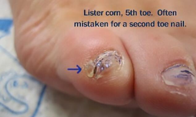 小脚趾的指甲盖分两瓣还有这种说法?关键勾住袜子后是真疼啊!