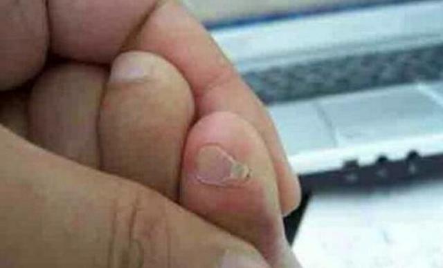 小脚趾的指甲盖分两瓣还有这种说法?关键勾住袜子后是真疼啊!