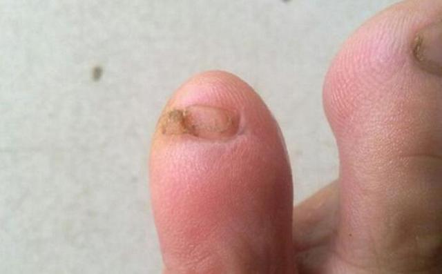 小脚趾的指甲盖分两瓣还有这种说法?关键勾住袜子后是真疼啊!