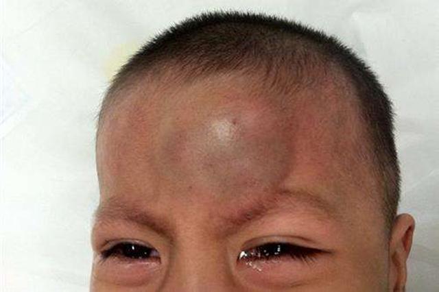 一旦摔到重要部位就不容小视,轻微的是皮外伤,比较重一些会引起脑震荡