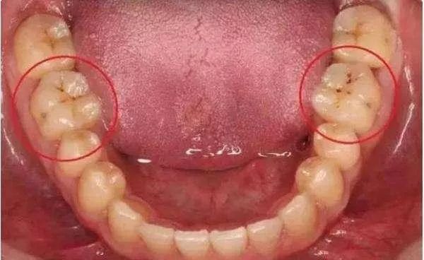 后槽牙在哪个位置图片