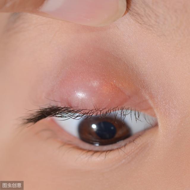 3岁女孩竟患蜂窝组织炎,只因妈妈当痘治,医生:乱挤针眼要不得|霰粒肿|