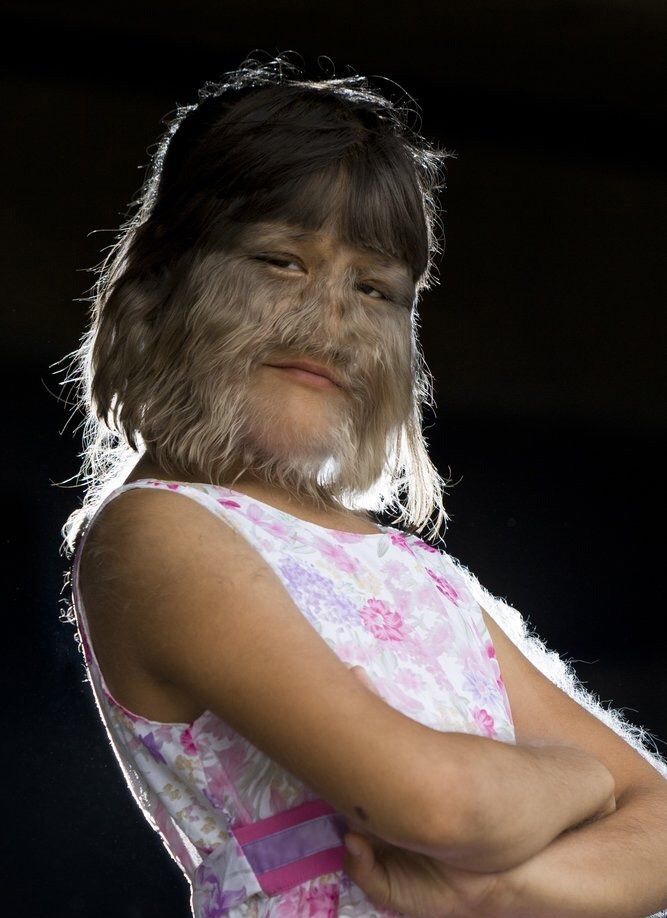 泰国12岁女孩脸上长满黑毛现已申请吉尼斯世界纪录